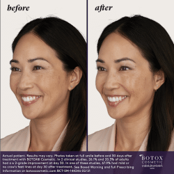 Botox Before & After results