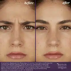 Botox Before & After results