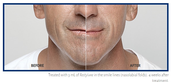 Restylane